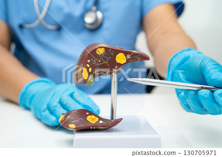 Cirrhosis, Liver cancer, fatty liver, Asian doctor with liver human anatomy model in World Hepatitis Day at hospital. 130705971