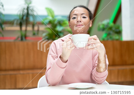 Black african american woman with vitiligo 130715595