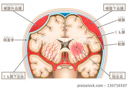 Illustrations of subarachnoid hemorrhage, epidural hematoma, subdural hematoma, and cerebral hemorrhage 130716587