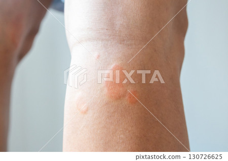 Young asian man has allergic skin rash on his legs from itchy dry skin eczema dermatitis insect bites 130726625