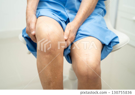 Asian elderly woman patient with scar knee replacement surgery in hospital. Asian elderly woman patient with scar knee replacement surgery in hospital. 130755836