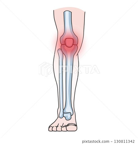 human knee joint with highlighted pain area, concept for arthritis, injury, and anatomy study. 130811342