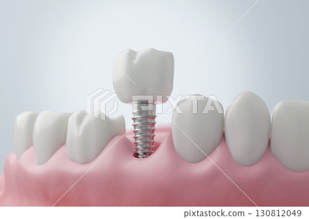 3D illustration of implant treatment: Treatment for back teeth lost due to periodontal disease 130812049