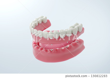 Lower jaw treatment with implant bridges: The latest technology to replace multiple missing teeth 130812283