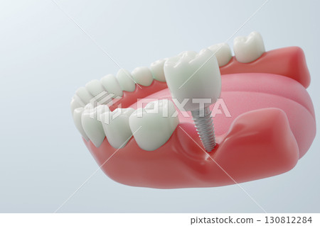 氧化鋯牙冠安裝:3D 視野中的植牙治療最後一步 氧化鋯牙冠安裝:3D 視野中的植牙治療最後一步 130812284