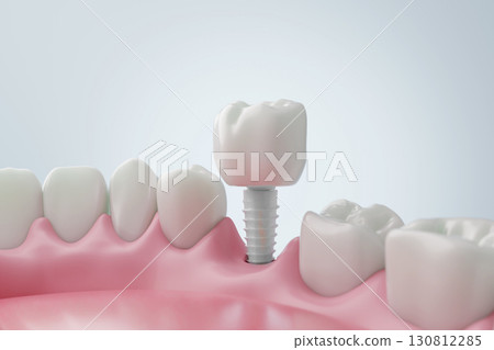 Zirconia implant treatment Dental treatment using ceramics viewed in 3D Zirconia implant treatment Dental treatment using ceramics viewed in 3D 130812285