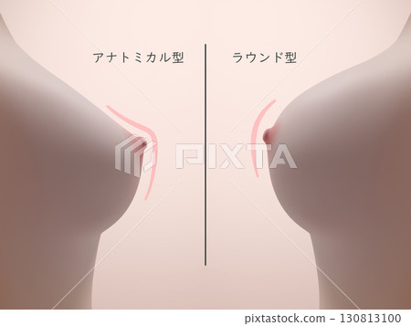 Before and after breast augmentation surgery: Comparison of round and teardrop breast augmentation 130813100