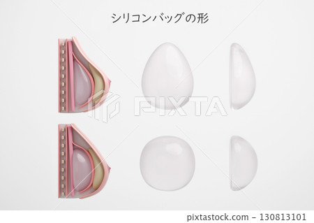 Comparison of breast implant shapes: Cross-section of round and teardrop types 130813101