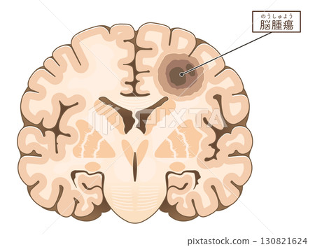 腦腫瘤插圖 130821624