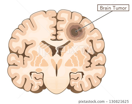 Brain tumor illustration Brain tumor illustration 130821625
