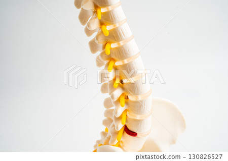 Lumbar spine displaced herniated disc fragment, spinal nerve and bone. Model for treatment medical in the orthopedic department. Lumbar spine displaced herniated disc fragment, spinal nerve and bone. Model for treatment medical in the orthopedic department. 130826527