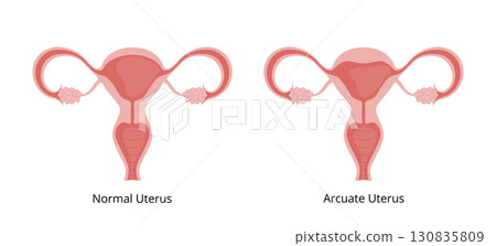 Normal Uterus and Arcuate Uterus Comparison 130835809