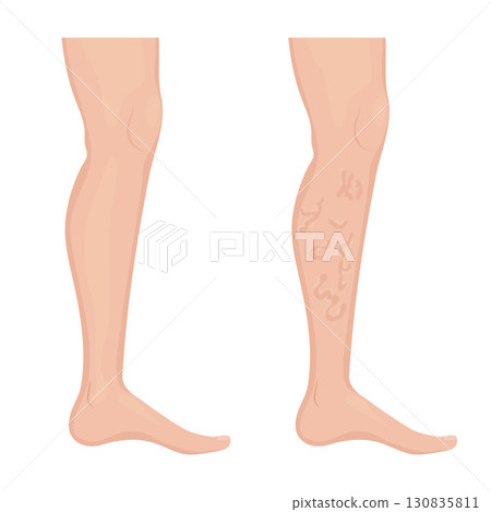 Comparing healthy leg with varicose veins, showing vascular disease development 130835811