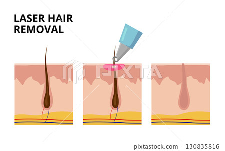 Laser hair removal treatment destroying hair follicle under skin 130835816