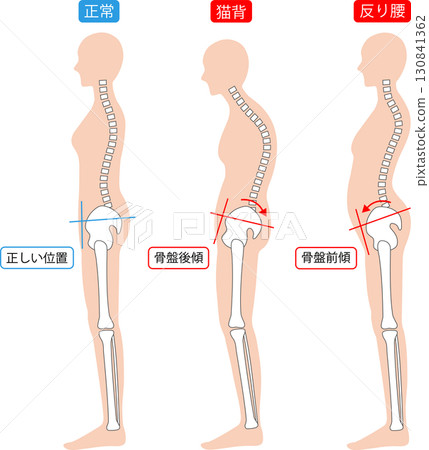 正確的姿勢和駝背和弓背女性的脊椎和骨盆 130841362