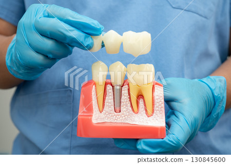 Dental implant, artificial tooth roots into jaw, root canal of dental treatment, gum disease, teeth model for dentist studying about dentistry. 130845600