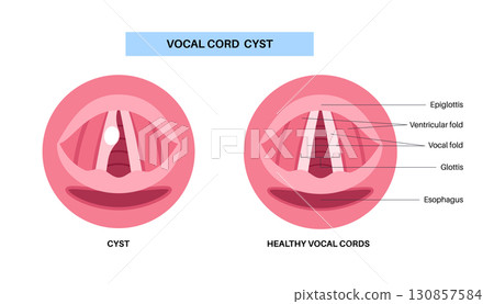 Vocal cord cyst Vocal cord cyst 130857584