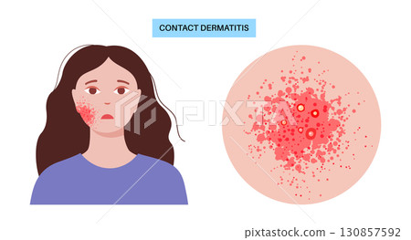 Contact dermatitis poster 130857592