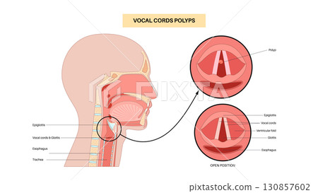 Vocal cord polyps 130857602