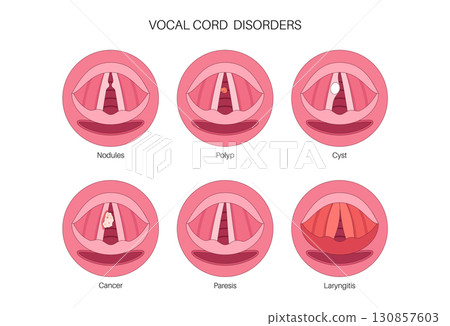 Vocal cord lesions Vocal cord lesions 130857603