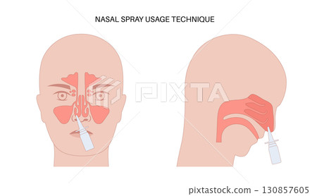 Proper nasal spray usage 130857605