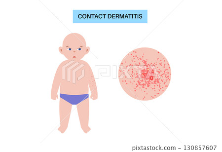 Contact dermatitis poster 130857607