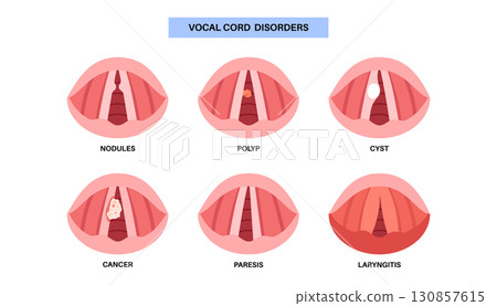 Vocal cord lesions Vocal cord lesions 130857615