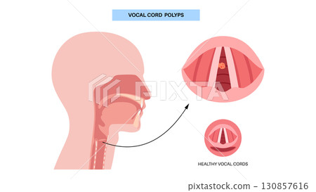 Vocal cord polyps 130857616