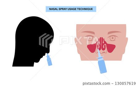 Proper nasal spray usage 130857619