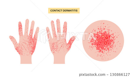 Contact dermatitis poster 130866127