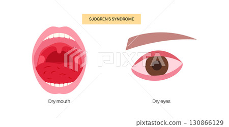 Sjogrens syndrome disease 130866129