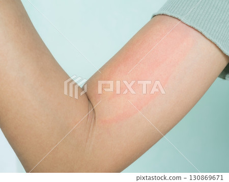 Hand with Urticaria Allergy Itchy Rash Eczema Itch Woman from Food,Air Poisoning,Cosmetic,Health,Body Care Disease Lilness Air,Dissease Medicine Calamine Lotion Treatment ,Infection Pain Sick Scratch. 130869671