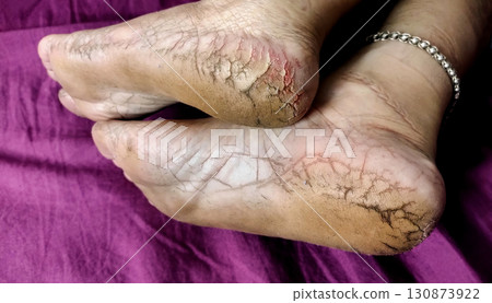 Close-Up of Cracked Heels and Bare Feet 130873922