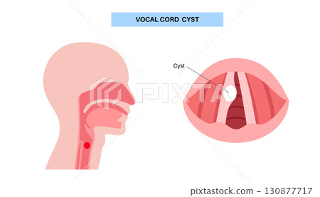 Vocal cord cyst 130877717