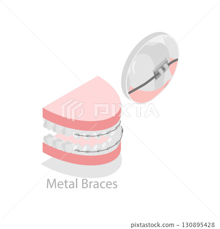 3D Isometric Flat Illustration of Dental Teeth Braces Types. Item 6 3D Isometric Flat Illustration of Dental Teeth Braces Types. Item 6 130895428
