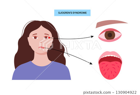 Sjogrens syndrome disease 130904922