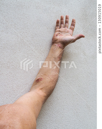 Electrical burn wounds showing entry and exit points on arm and hand Electrical burn wounds showing entry and exit points on arm and hand 130915019