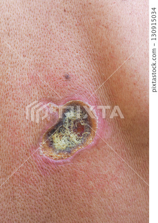 Electric shock causing skin lesion on adult caucasian man Electric shock causing skin lesion on adult caucasian man 130915034
