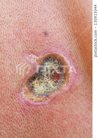 Electric shock causing skin wound on caucasian man 130915044