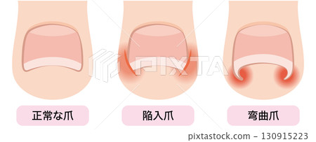 Ingrown nails, ingrown nails, curved nails 130915223