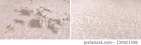 Skin surface before and after the melasma treatment procedure. 3D-rendered illustration showing reduce pigmentation and dark spots after laser therapy, microneedling, chemical peels, or topical creams 130921396