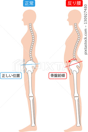 Swayback and normal posture of a woman - spine and pelvis 130927480