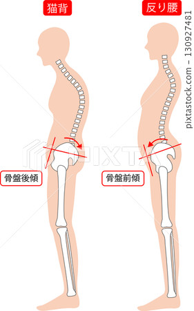 駝背和弓背的女性：脊椎和骨盆 130927481