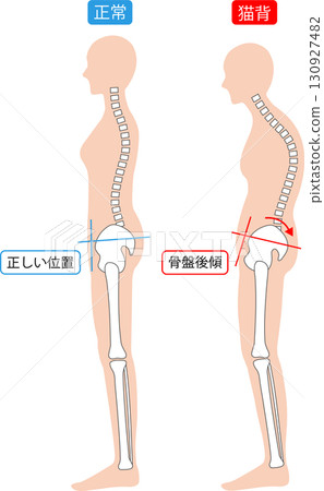 駝背和弓背的女性：脊椎和骨盆 130927482