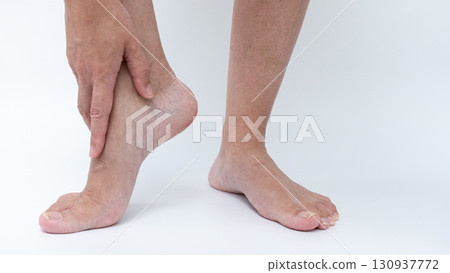 Varicose veins and spider veins treatment on legs, highlighting skin texture and foot positioning, showcasing effective healthcare solutions for vascular issues Varicose veins and spider veins treatment on legs, highlighting skin texture and foot positioning, showcasing effective healthcare solutions for vascular issues 130937772