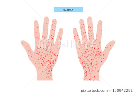 Eczema medical poster 130942291