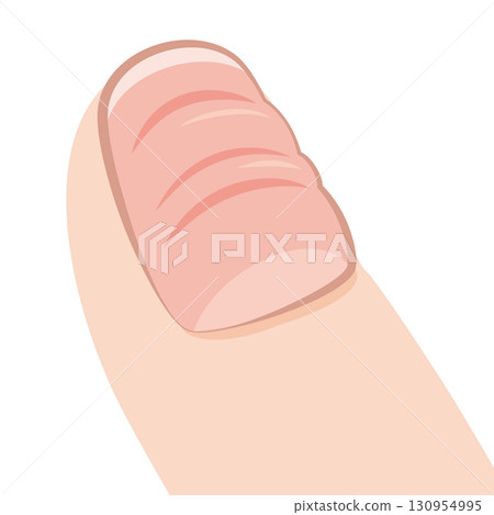 bumpy nails 130954995