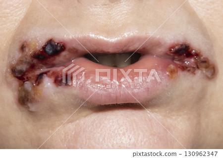 Infection on lips. Crack in the corner of the mouth, sores around the mouth, sore on the lips with dry blood on the woman face. Infection on lips. Crack in the corner of the mouth, sores around the mouth, sore on the lips with dry blood on the woman face. 130962347