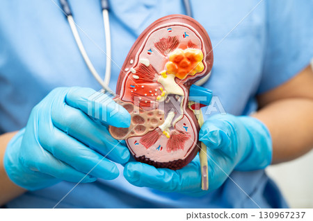 Chronic kidney disease, doctor with model for treatment urinary system, urology, Estimated glomerular filtration rate eGFR. 130967237