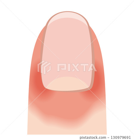 Candidal paronychia nails 130979691